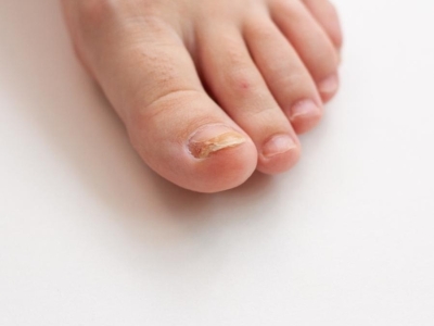 Mycoses des ongles de pieds