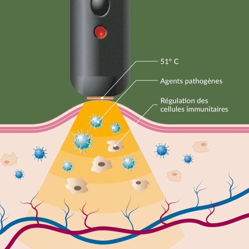 Herpotherm® contre les boutons de fièvre - traiter sans chimie