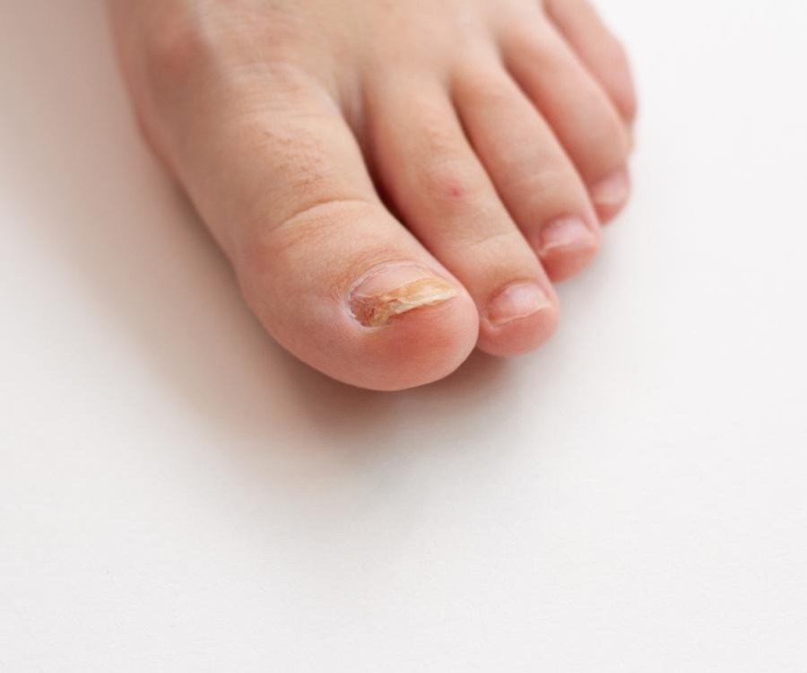 Mycoses des ongles de pieds
