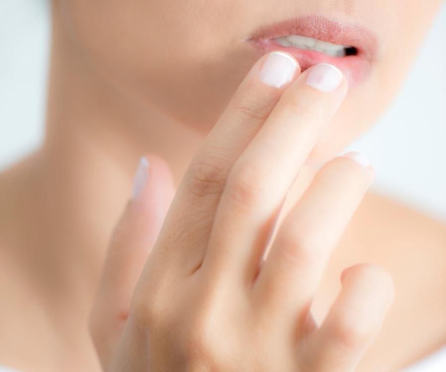 Herpès buccal