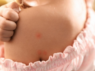 Une piqûre d'insecte