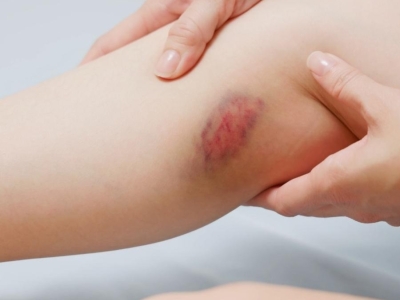 Bleus, coups, bosses ...