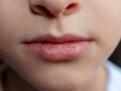 Crevasses et gerçures