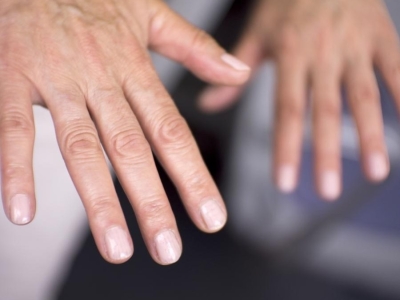 La polyarthrite rhumatoïde